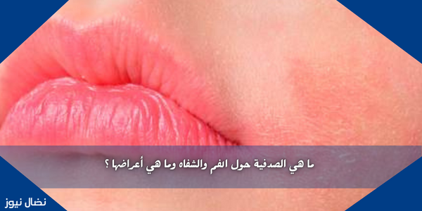 ما هي الصدفية حول الفم والشفاه وما هي أعراضها ؟